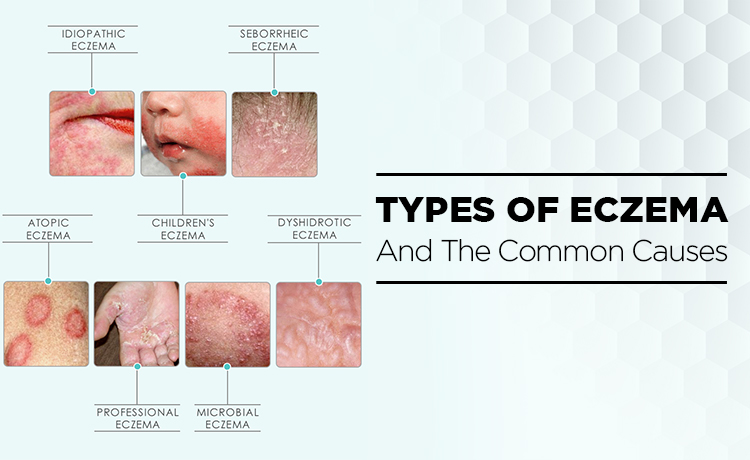 Types Of Eczema And The Common Causes Blog Featured Image