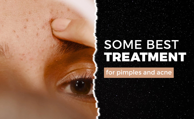 Some best treatment for pimples and acne blog featured image