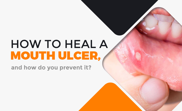 How To Heal A Mouth Ulcer, And How Do You Prevent It? Blog Featured Image