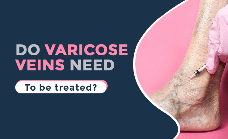 Do varicose veins need to be treated blog featured image