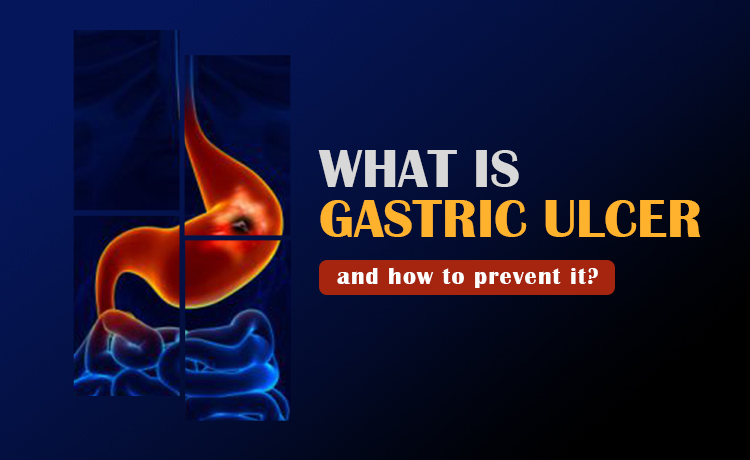 What Is Gastric Ulcers And How To Prevent It Blog Featured Image