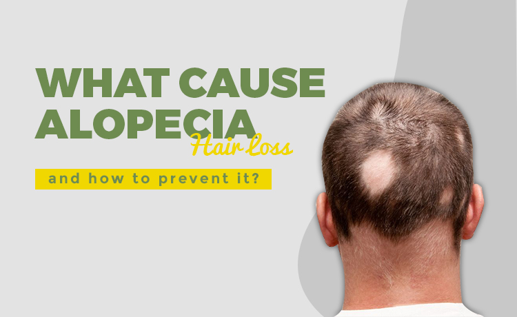 How To Prevent Alopecia Blog Featured Image