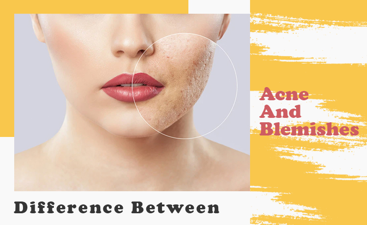 Difference Between Acne And Blemishes Blog Featured Image