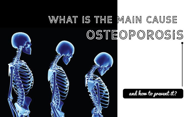 Leading Cause Of Osteoporosis And How To Prevent It Blog Featured Image