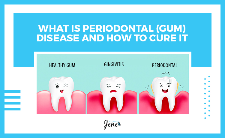 What Is Periodontal Disease And How To Cure It Blog Featured Image