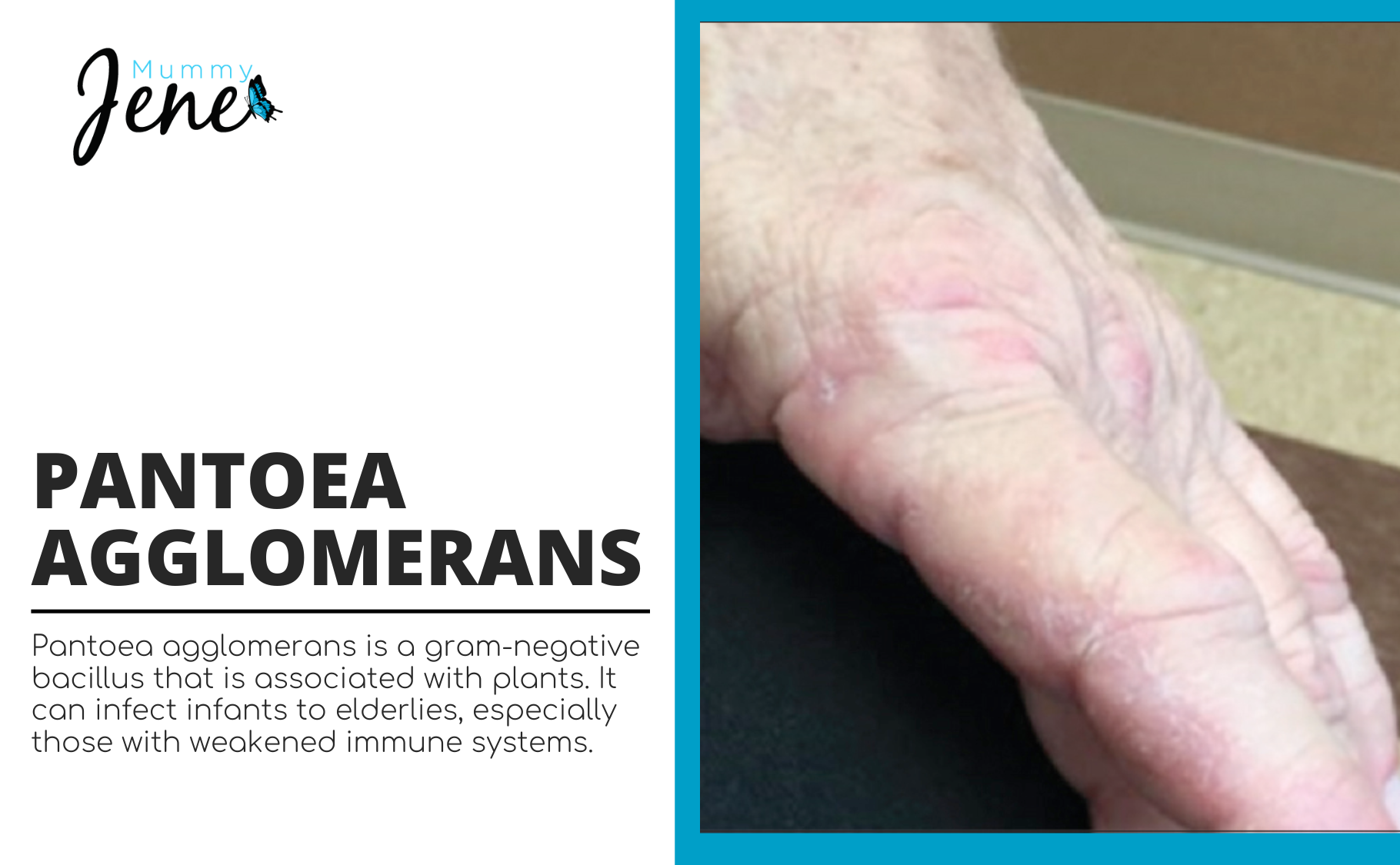 Causes Of Pantoea Agglomerans And Treatments Blog Featured Image