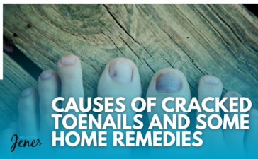 Causes Of Cracked Toenails And Some Home Remedies Blog Featured Image